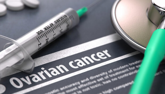 A Comprehensive Guide on Ovarian Cancer