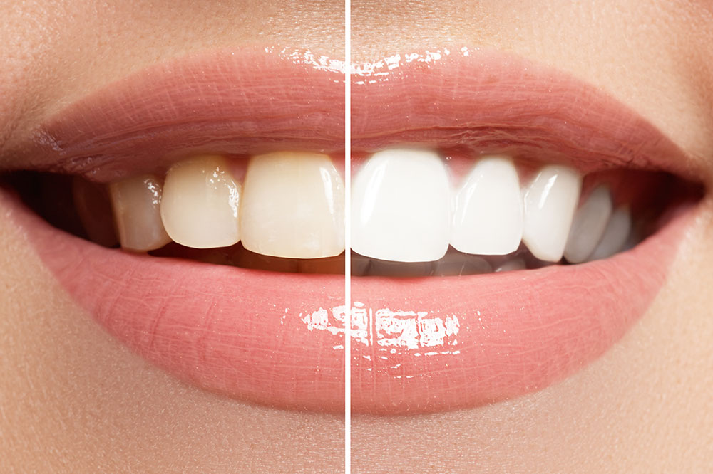 Teeth-Whitening – Benefits and Risks