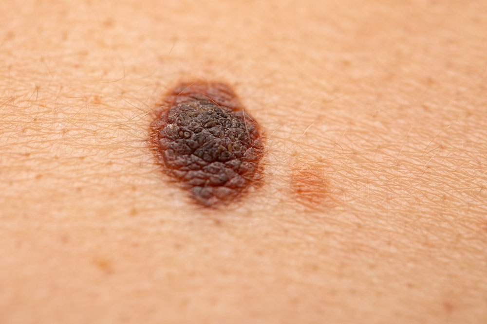 Top Melanoma Causes to Keep in Mind